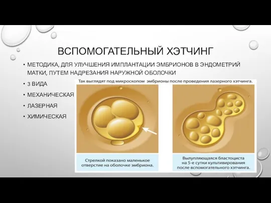 ВСПОМОГАТЕЛЬНЫЙ ХЭТЧИНГ МЕТОДИКА, ДЛЯ УЛУЧШЕНИЯ ИМПЛАНТАЦИИ ЭМБРИОНОВ В ЭНДОМЕТРИЙ МАТКИ, ПУТЕМ