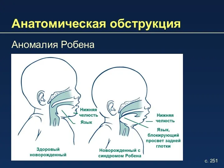 Анатомическая обструкция Аномалия Робена с. 251