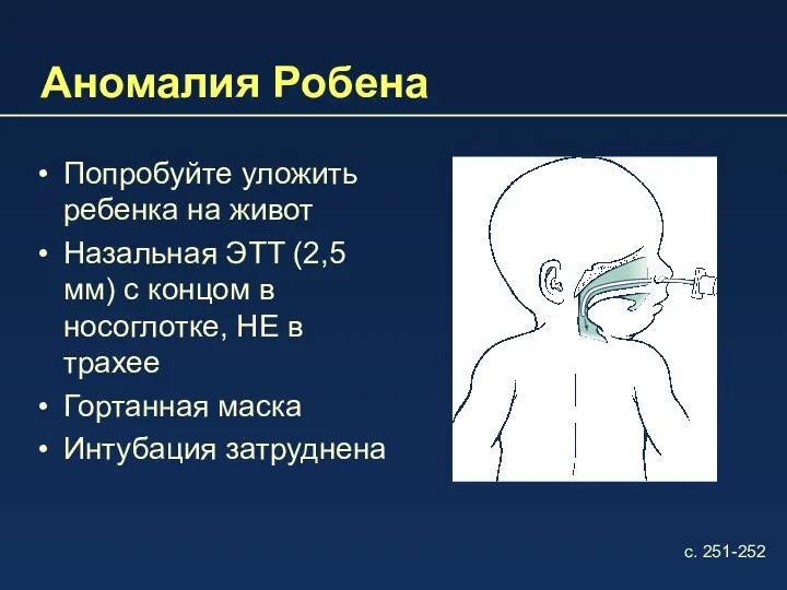 Аномалия Робена Попробуйте уложить ребенка на живот Назальная ЭTT (2,5 мм)