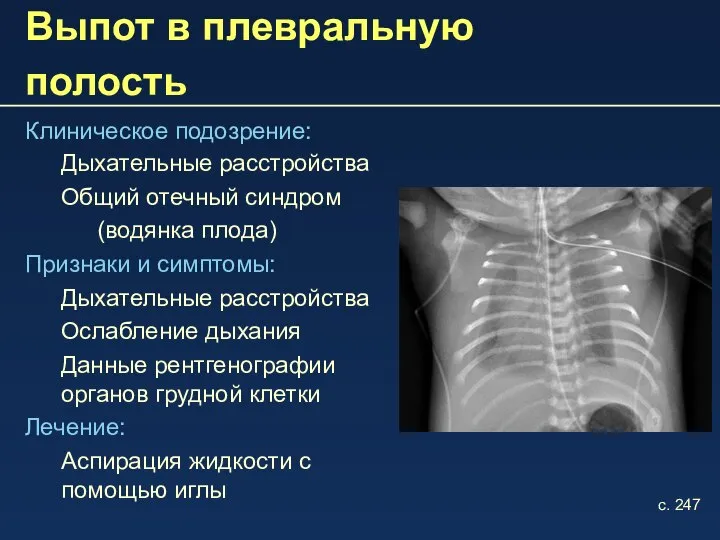 Выпот в плевральную полость Клиническое подозрение: Дыхательные расстройства Общий отечный синдром