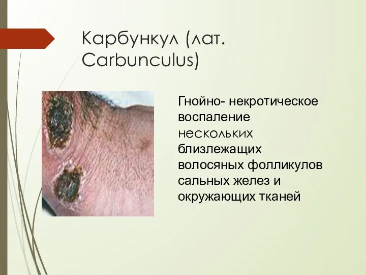 Карбункул (лат. Carbunculus) Гнойно- некротическое воспаление нескольких близлежащих волосяных фолликулов сальных желез и окружающих тканей