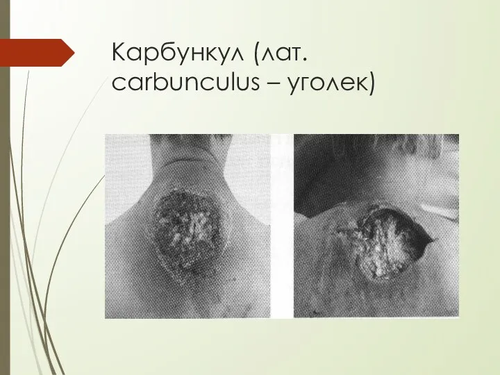 Карбункул (лат. carbunculus – уголек) В процессе лечения