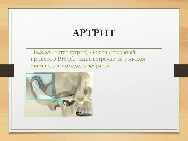 АРТРИТ Артрит (остеоартрит) - воспалительный процесс в ВНЧС. Чаще встречается у людей старшего и молодого возраста.