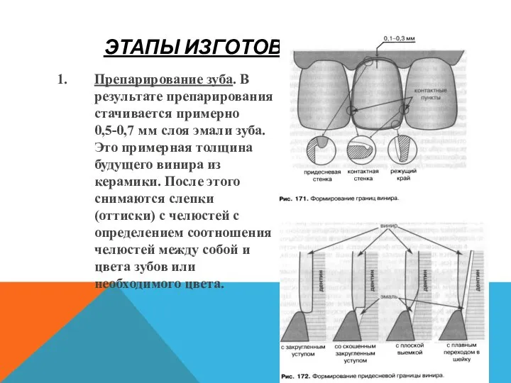 ЭТАПЫ ИЗГОТОВЛЕНИЯ ВИНИРОВ Препарирование зуба. В результате препарирования стачивается примерно 0,5-0,7