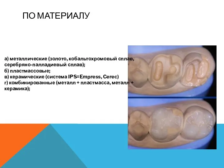 ПО МАТЕРИАЛУ а) металлические (золото, кобальтохромовый сплав, серебряно-палладиевый сплав); б) пластмассовые;