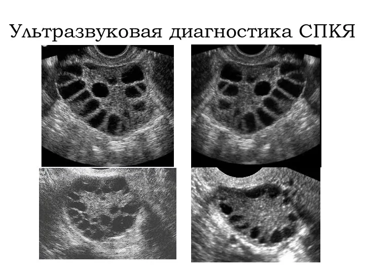 Ультразвуковая диагностика СПКЯ