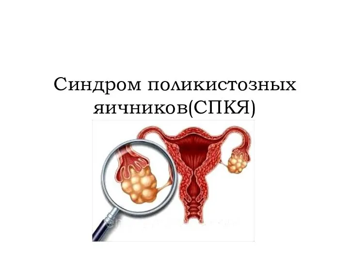 Синдром поликистозных яичников(СПКЯ)