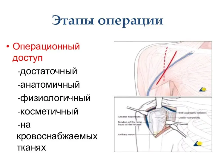 Этапы операции Операционный доступ -достаточный -анатомичный -физиологичный -косметичный -на кровоснабжаемых тканях