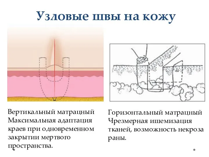 Узловые швы на кожу Вертикальный матрацный Максимальная адаптация краев при одновременном