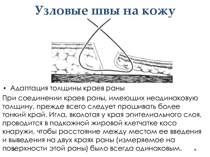 Узловые швы на кожу Адаптация толщины краев раны При соединении краев