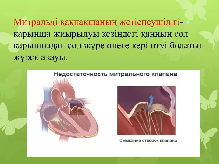 Митральді қақпақшаның жетіспеушілігі- қарынша жиырылуы кезіндегі қанның сол қарыншадан сол жүрекшеге кері өтуі болатын жүрек ақауы.