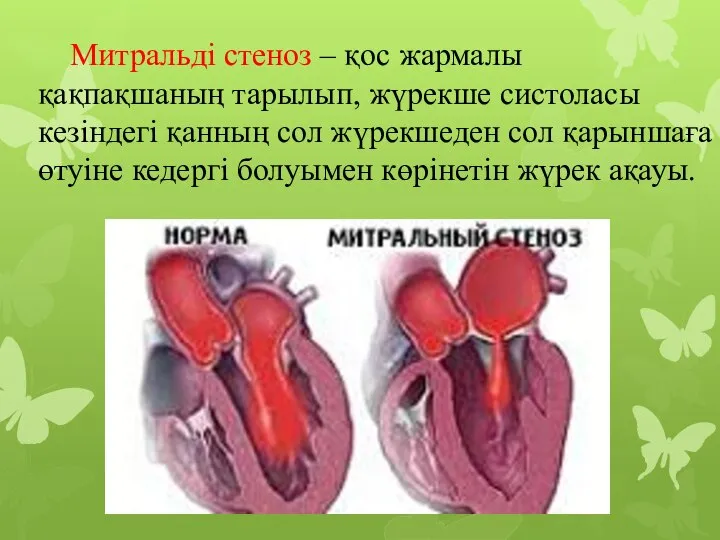 Митральді стеноз – қос жармалы қақпақшаның тарылып, жүрекше систоласы кезіндегі қанның