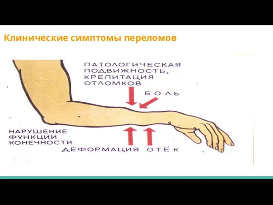 Клинические симптомы переломов