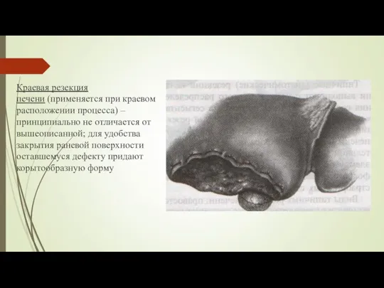 Краевая резекция печени (применяется при краевом расположении процесса) – принципиально не