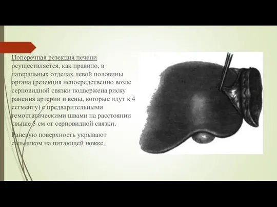 Поперечная резекция печени осуществляется, как правило, в латеральных отде­лах левой половины