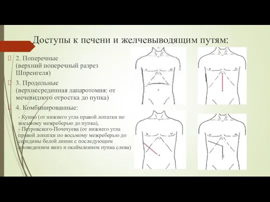 Доступы к печени и желчевыводящим путям: 2. Поперечные (верхний поперечный разрез