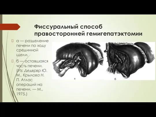 Фиссуральный способ правосторонней гемигепатэктомии а — разделение печени по ходу средин­ной