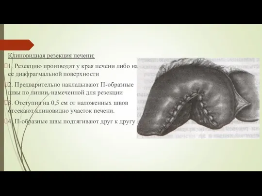 Клиновидная резекция печени: 1. Резекцию производят у края печени либо на