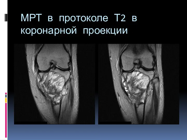 МРТ в протоколе Т2 в коронарной проекции