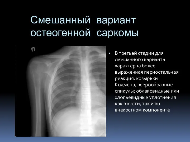 Смешанный вариант остеогенной саркомы В третьей стадии для смешанного варианта характерна