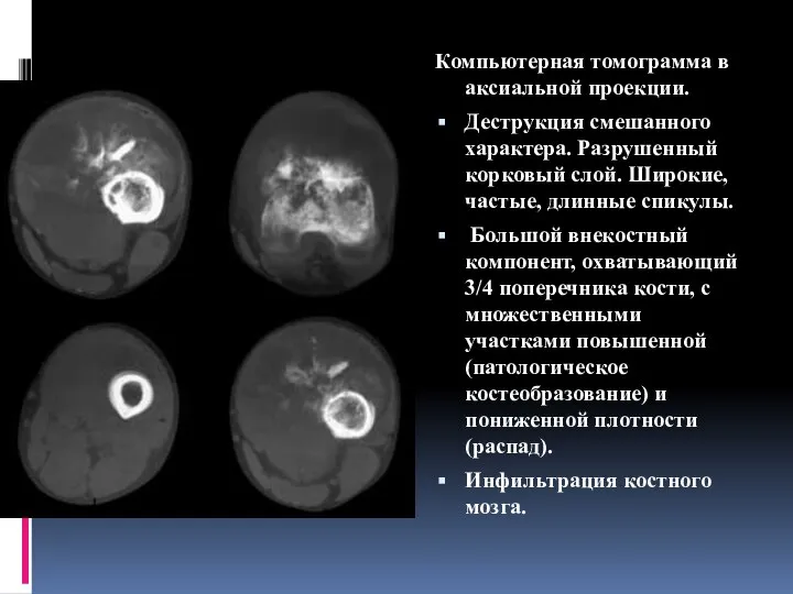 Компьютерная томограмма в аксиальной проекции. Деструкция смешанного характера. Разрушенный корковый слой.