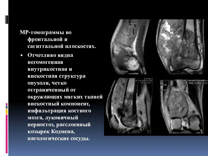 МР-томограммы во фронтальной и сагиттальной плоскостях. Отчетливо видна негомогенная внутрикостная и