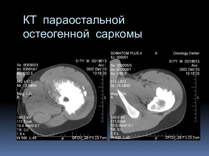 КТ параостальной остеогенной саркомы