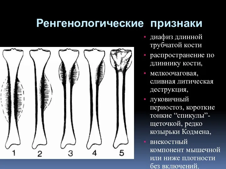 Ренгенологические признаки диафиз длинной трубчатой кости распространение по длиннику кости, мелкоочаговая,