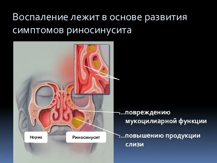 Клиника синуситов. Диагностика. Осложнения синуситов