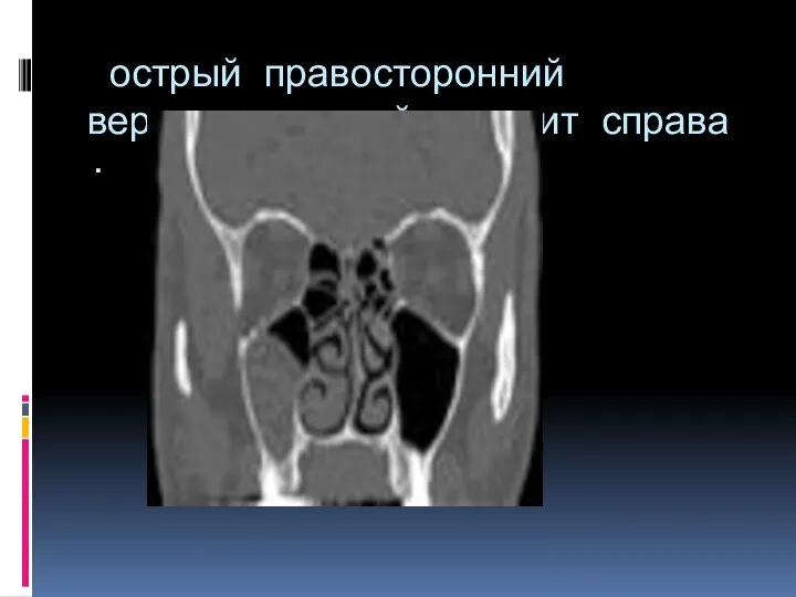 острый правосторонний верхнечелюстной синусит справа