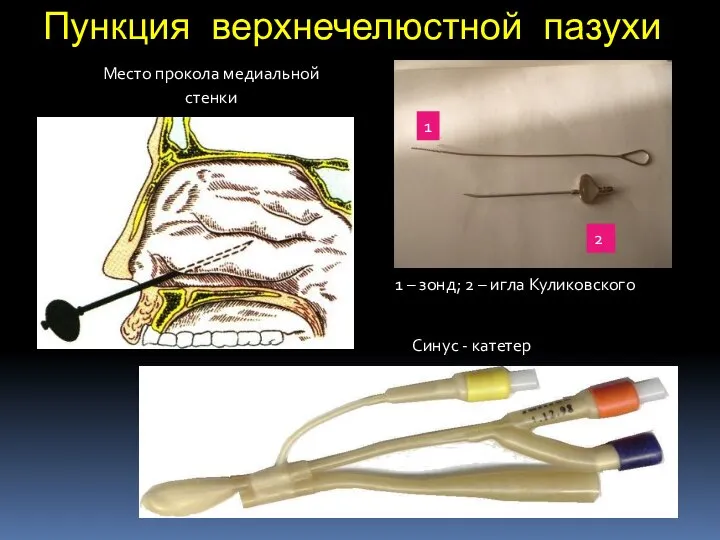 Пункция верхнечелюстной пазухи Место прокола медиальной стенки Синус - катетер 1