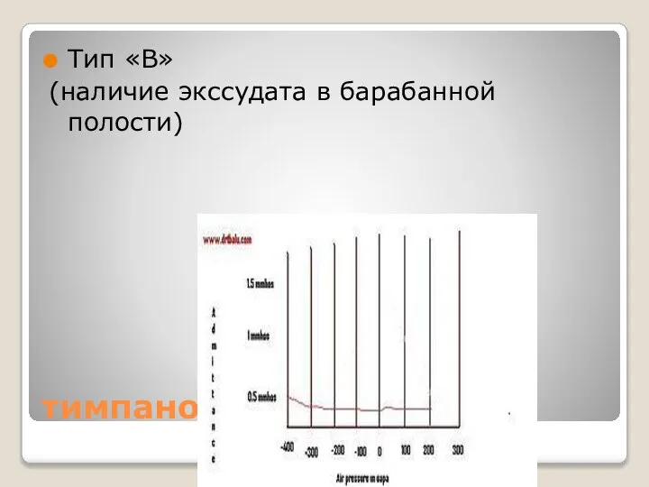 тимпанометрия Тип «В» (наличие экссудата в барабанной полости)