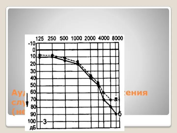 Аудиограмма при поражения слухового нерва(нейросенсорная)