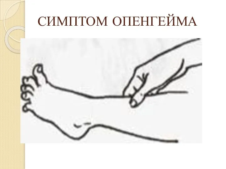 СИМПТОМ ОПЕНГЕЙМА