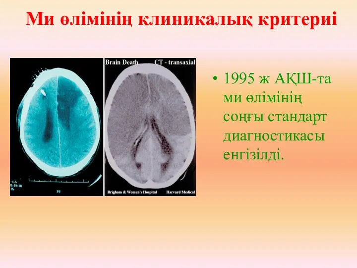 1995 ж АҚШ-та ми өлімінің соңғы стандарт диагностикасы енгізілді. Ми өлімінің клиникалық критериі