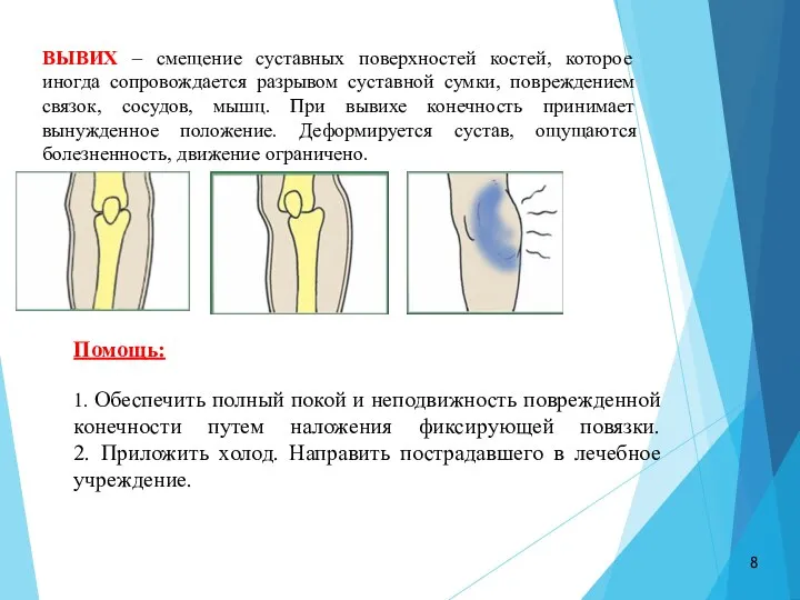 ВЫВИХ – смещение суставных поверхностей костей, которое иногда сопровождается разрывом суставной