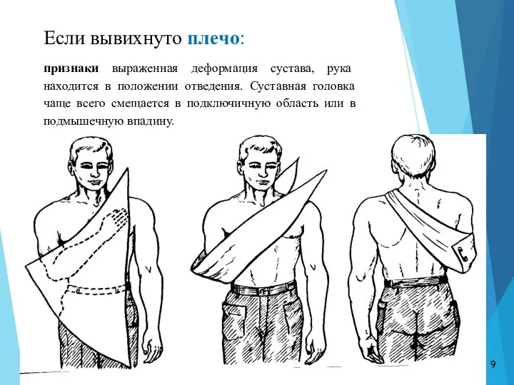 Если вывихнуто плечо: признаки выраженная деформация сустава, рука находится в положении