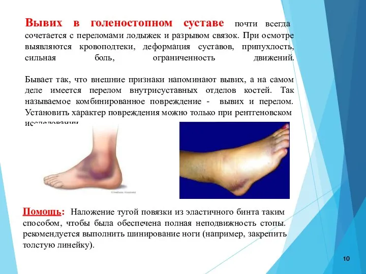 Вывих в голеностопном суставе почти всегда сочетается с переломами лодыжек и