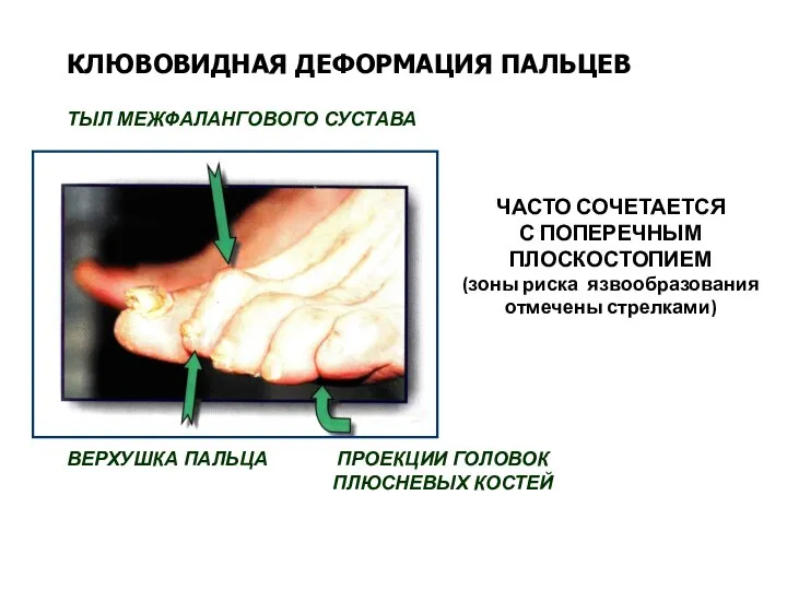 ТЫЛ МЕЖФАЛАНГОВОГО СУСТАВА ВЕРХУШКА ПАЛЬЦА ПРОЕКЦИИ ГОЛОВОК ПЛЮСНЕВЫХ КОСТЕЙ КЛЮВОВИДНАЯ ДЕФОРМАЦИЯ