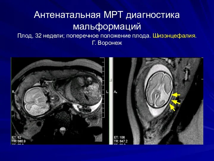 Антенатальная МРТ диагностика мальформаций Плод, 32 недели; поперечное положение плода. Шизэнцефалия. Г. Воронеж