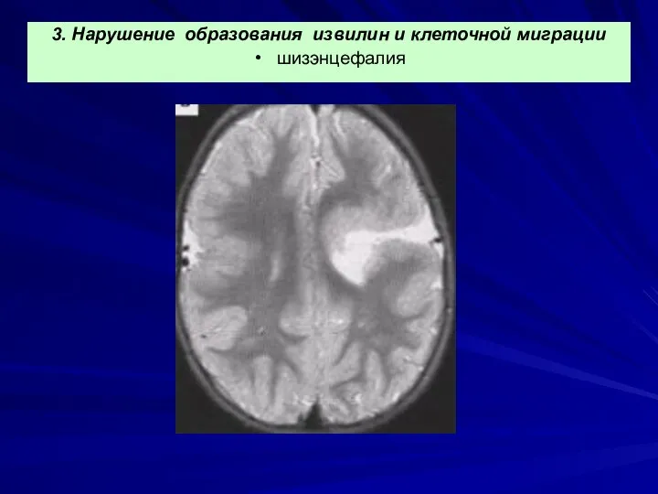 3. Нарушение образования извилин и клеточной миграции шизэнцефалия