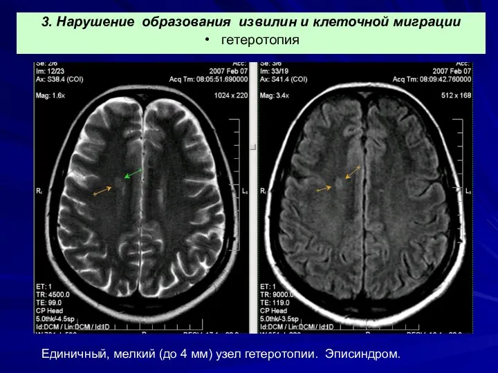 Единичный, мелкий (до 4 мм) узел гетеротопии. Эписиндром. 3. Нарушение образования извилин и клеточной миграции гетеротопия