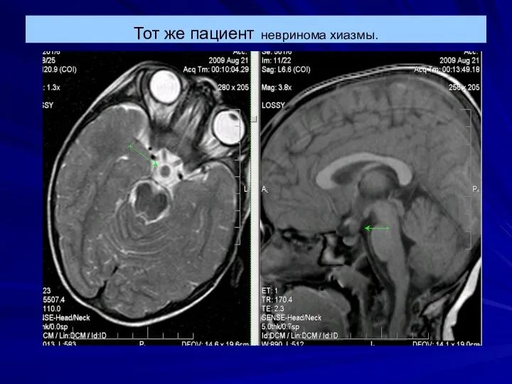 Тот же пациент невринома хиазмы.