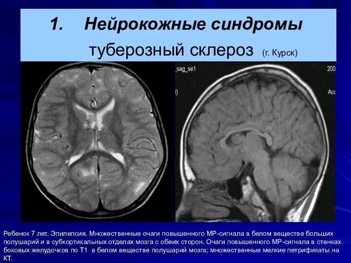 Ребенок 7 лет. Эпилепсия. Множественные очаги повышенного МР-сигнала в белом веществе