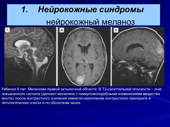 Ребенок 9 лет. Меланома правой затылочной области. В Т2-сагиттальной плоскости –