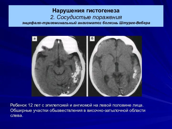 Нарушения гистогенеза 2. Сосудистые поражения энцефало-тригеминальный ангиоматоз болезнь Штурге-Вебера Ребенок 12