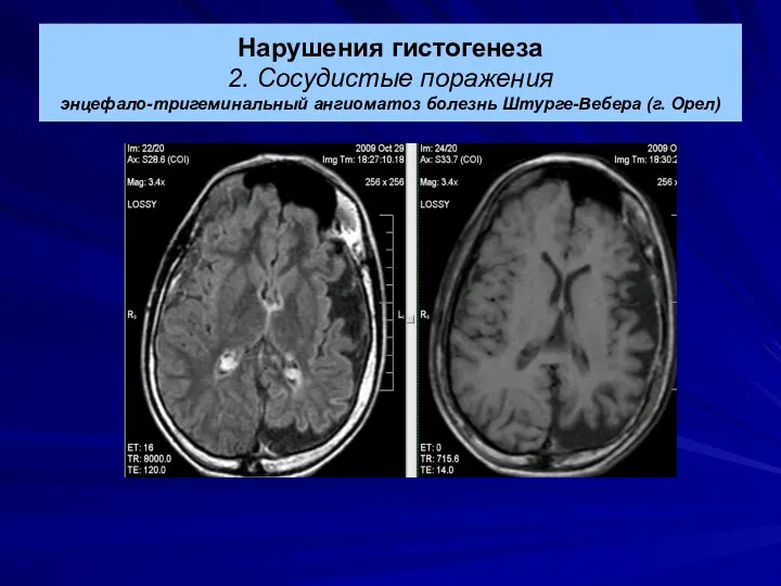 Нарушения гистогенеза 2. Сосудистые поражения энцефало-тригеминальный ангиоматоз болезнь Штурге-Вебера (г. Орел)