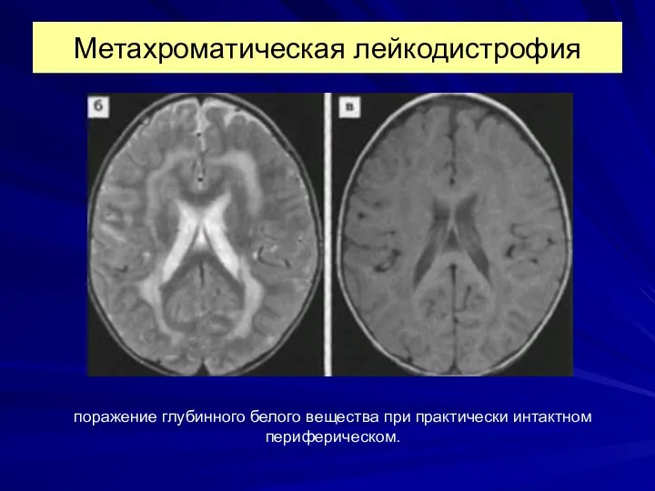 Метахроматическая лейкодистрофия поражение глубинного белого вещества при практически интактном периферическом.