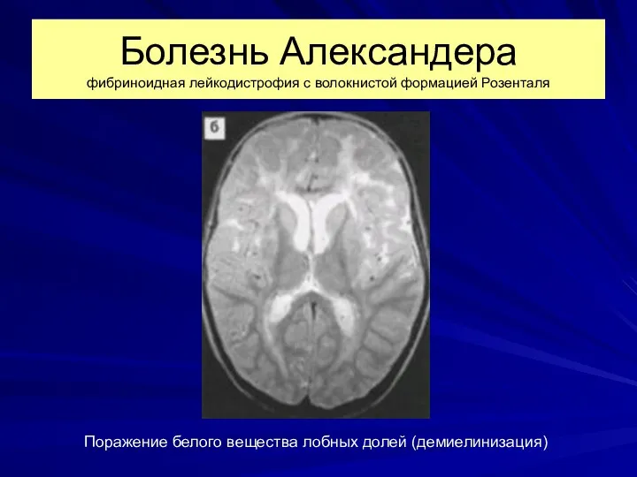 Болезнь Александера фибриноидная лейкодистрофия с волокнистой формацией Розенталя Поражение белого вещества лобных долей (демиелинизация)