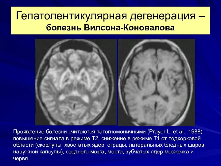 Гепатолентикулярная дегенерация – болезнь Вилсона-Коновалова Проявление болезни считаются патогномоничными (Prayer L.